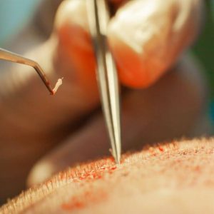 Transplantation techniques